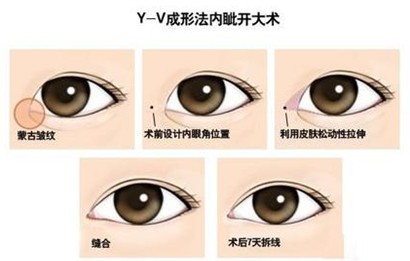 开眼角手术,吉林铭医,整形手术