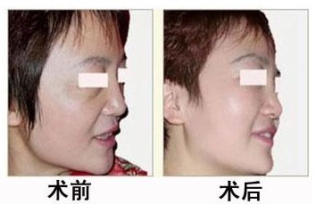 吉林铭医整形,玻尿酸除皱,长春微整形