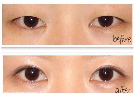 吉林铭医,开眼角,长春眼部整形