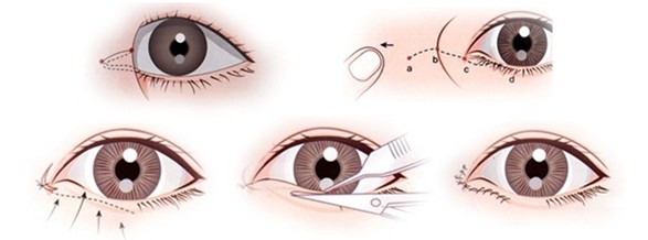开内眼角,开外眼角,吉林铭医,长春眼部整形