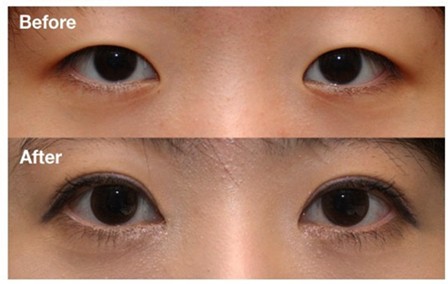 开内眼角,开外眼角,吉林铭医,长春眼部整形