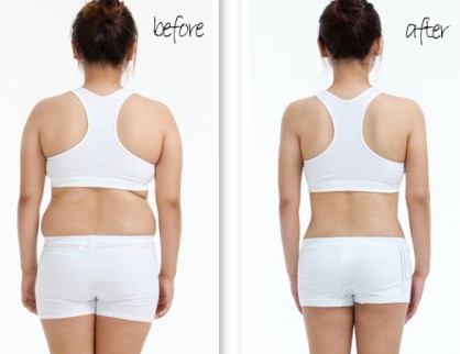 水动力吸脂,吉林铭医