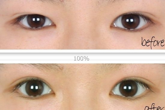 吉林铭医,上睑下垂