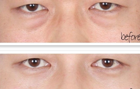 吉林铭医,长春去眼袋