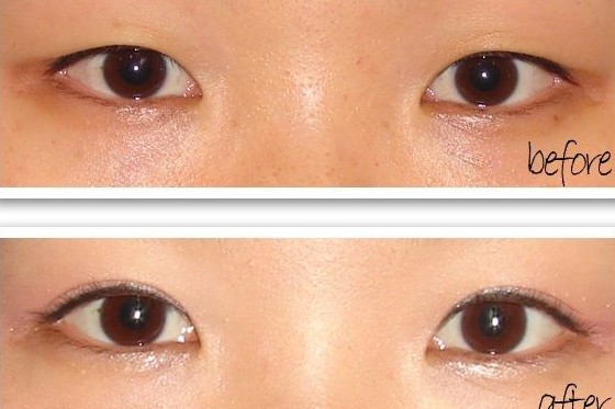 重睑术,吉林铭医