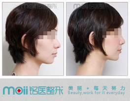 注射丰脸颊,吉林铭医,对身体没有伤害注射丰面颊,玻尿酸,botox