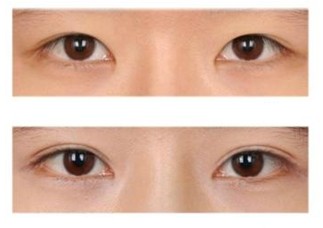 双眼皮手术,铭医专家,吉林铭医,长春铭医