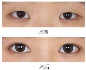开眼角手术费用,开眼角手术效果,吉林铭医