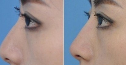 韩式隆鼻,吉林铭医,整形