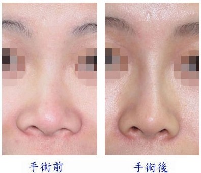 隆鼻尖术,长春隆鼻,吉林铭医