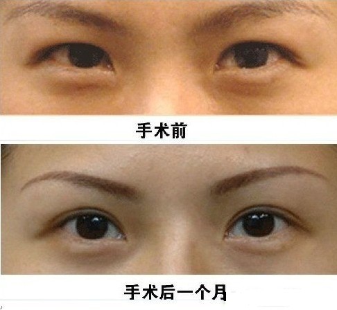 肿泡眼,吉林铭医,眼部整形