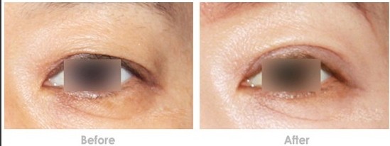 上睑下垂矫正术,吉林铭医,眼部整形