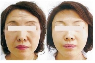 玻尿酸塑形,吉林铭医,微整形