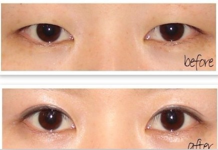 重睑术术前要做好哪些准备 铭医专家告诉你闪亮双眸的秘密