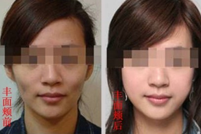 长春微整形专家：选择吉林铭医自体脂肪细胞移植4大理由