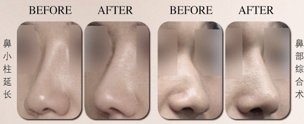 隆鼻,假体隆鼻,吉林铭医,膨体隆鼻,韩式隆鼻