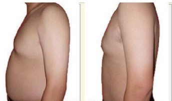 吉林铭医,男性吸脂