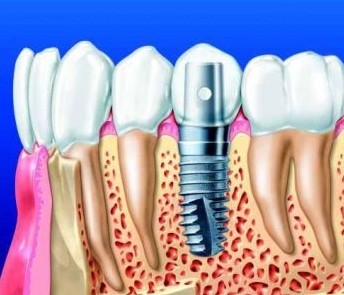 种植牙,种植牙效果,吉林铭医