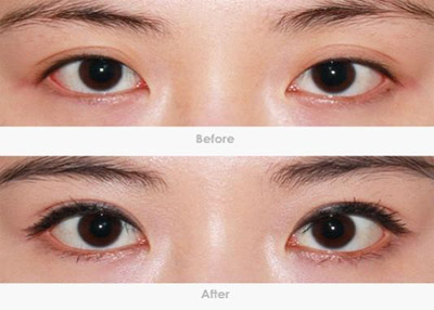 吉林铭,开眼角,开眼角对比图