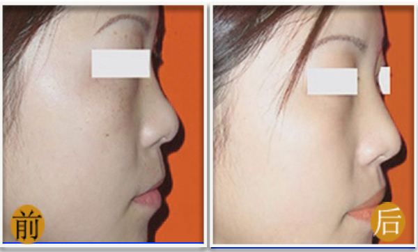 吉林铭医隆鼻整形让我精致蜕变