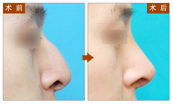 开运整形,隆鼻,吉林铭医,注射玻尿酸隆鼻