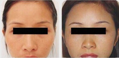 吉林铭医,自体脂肪填充