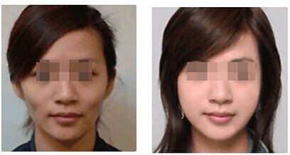 吉林铭医,自体脂肪填充