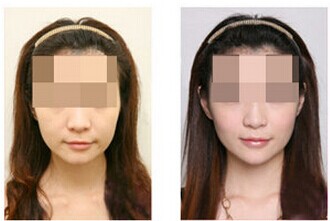 吉林铭医,自体脂肪填充