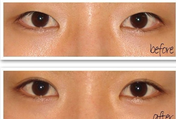 韩式双眼皮,对比图,长春好的整形医院