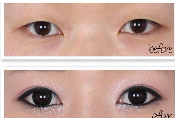 开眼角,双眼皮术