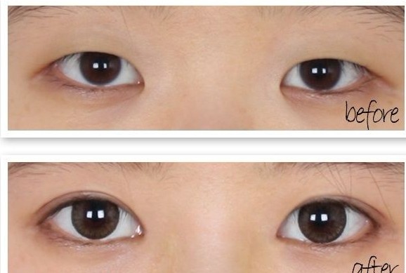 吉林铭医整形双眼皮对比图