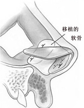 猪鼻子,隆鼻,吉林铭医 猪鼻子,隆鼻,吉林铭医