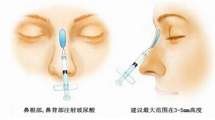 猪鼻子,隆鼻,吉林铭医 猪鼻子,隆鼻,吉林铭医