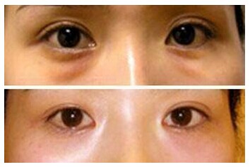 韩式眼袋去除,吉林铭医