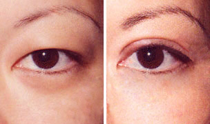 双眼皮,类型,对比图,吉林铭医