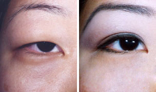 双眼皮,类型,对比图,吉林铭医