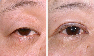 双眼皮,类型,对比图,吉林铭医