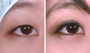 双眼皮,类型,对比图,吉林铭医