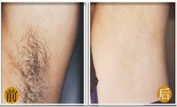冰点脱毛