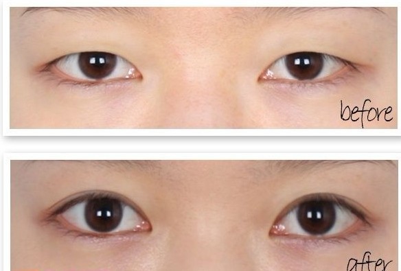 开眼角手术,吉林铭医