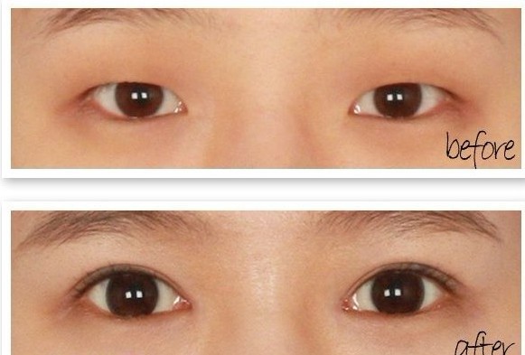 微创双眼皮,吉林铭医