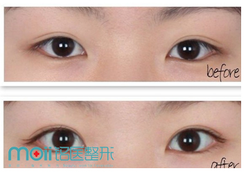 吉林铭医整形埋线双眼皮前后对比图