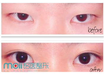 韩式埋线双眼皮