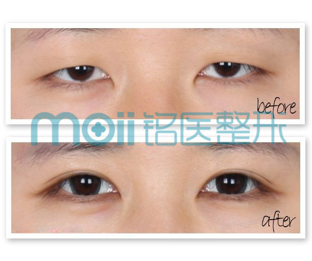 对比图,长春好的整形医院