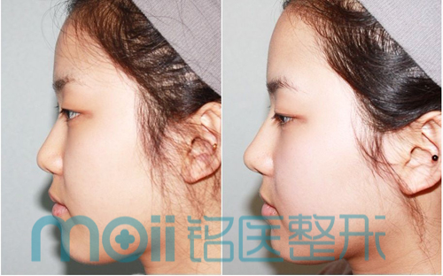 隆鼻,对比图,长春好的整形医院