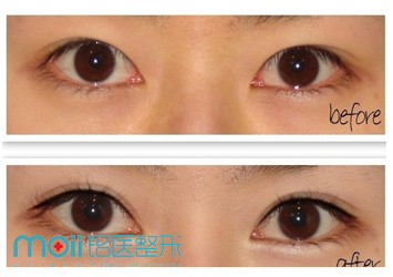 韩式三点双眼皮,吉林铭医