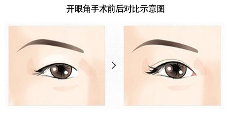 开眼角,对比图,长春好的整形医院