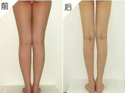 吸脂瘦腿术 效果非凡肥胖部位