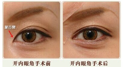 单眼皮,开眼角