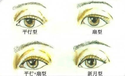 双眼皮形状,长春好的整形医院